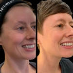 Profhilo in Dubai A Celebrity-Favorite Treatment for Radiant Skin