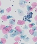 Liquid-Based Cytology