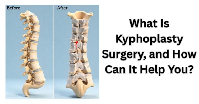 What Is Kyphoplasty Surgery, and How Can It Help You?
