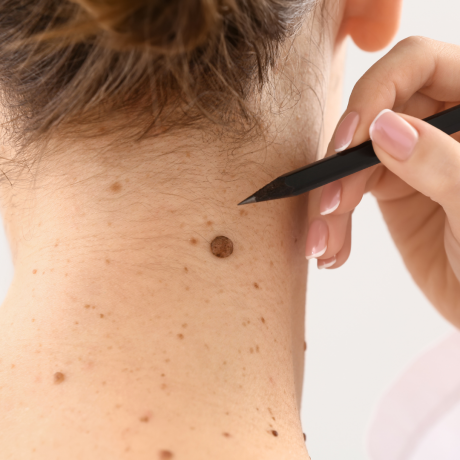 Cosmetic Mole Removal Pricing in California
