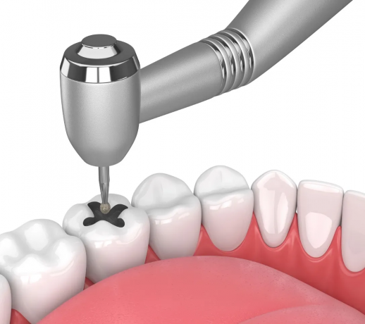 How Dental Fillings Help Prevent Tooth Loss?