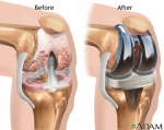 Risks and Complications of Knee Replacement Surgery: A Complete Guide