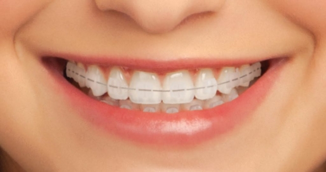Smile Support, A Guide to Dental Appliances