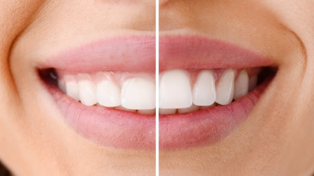 Gingivectomy, Benefits, Risks, and Everything in Between
