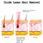 755nm+808nm+940nm+1064nm Portable Diode Laser Hair Removal Machine