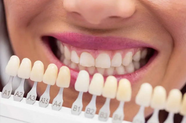 Top Benefits of Choosing E-Max Veneers for Your Smile