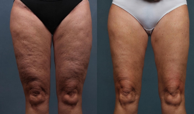 Laser Therapy for Cellulite: Is It Worth It in Islamabad?