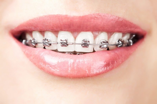 How to Keep Your Smile Clean with Metal Braces?