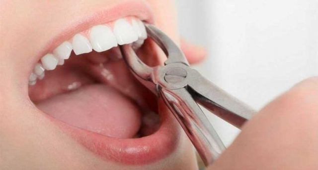 Why Is Dental Filling Essential For Tooth Cavities?