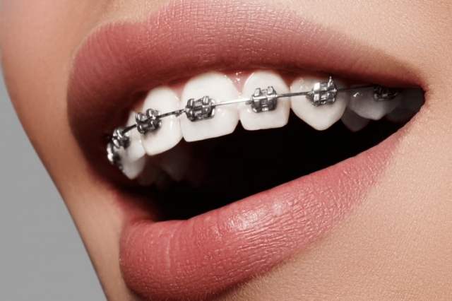 Orthodontist vs. Dentist, Who Handles Braces Best?