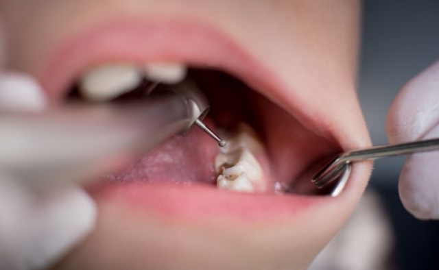Metal-Free Fillings, The Modern Alternative to Silver