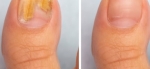 When Nail Fungus Becomes Serious – Get Treated in Singapore
