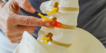 Spinal Cord Abscess: Why Delaying Treatment Can Be Life-Threatening | Best Spine Doctor in Delhi