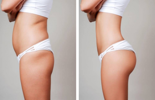 Why Liposuction in Mumbai is the Best Choice for Body Contouring