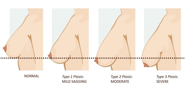 What Should You Know Before Choosing a Breast Lift in Mumbai?