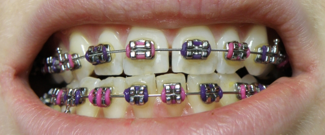 Common Mistakes to Avoid While Using Braces: A Patient’s Guide