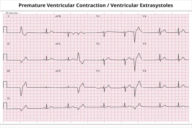 Why Are More People Choosing PVC Ablation for Heart Rhythm Issues?
