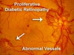 PDR Proliferative Diabetic Retinopathy: Top Questions Answered by Eye Specialists