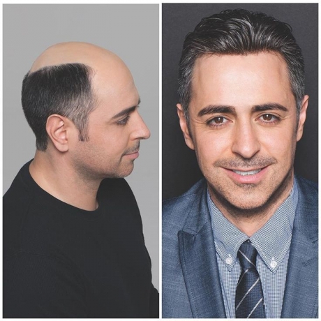 Hair Restore Transplant Center Peshawar: Natural-Looking Results