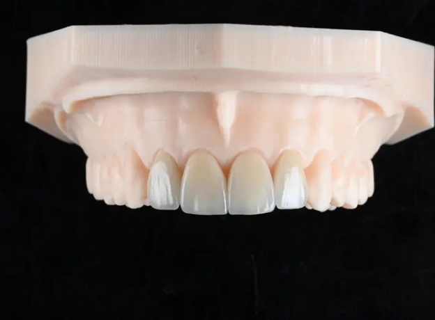 Zirconia Veneer