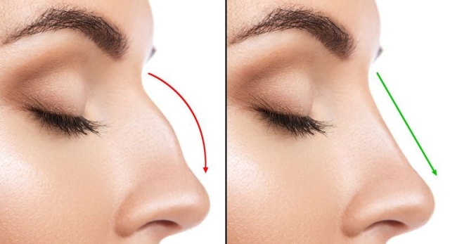 How Much Does a Nose Job (Rhinoplasty) Cost in the UK?