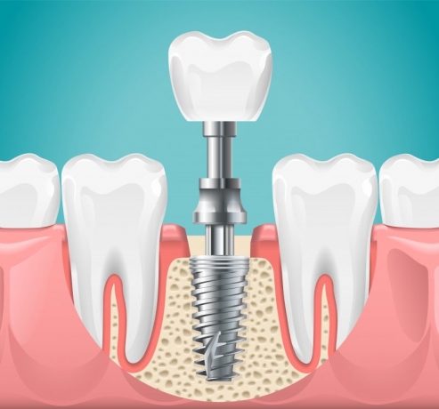 Am I a Candidate for Dental Implants?