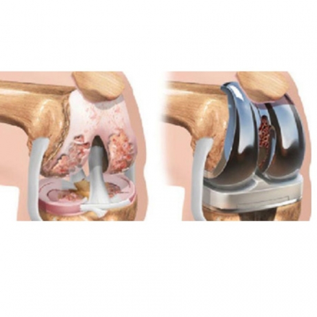 Knee Replacement