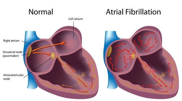 Living with AFib? Discover Natural and Holistic Cures in Los Angeles and Burbank 