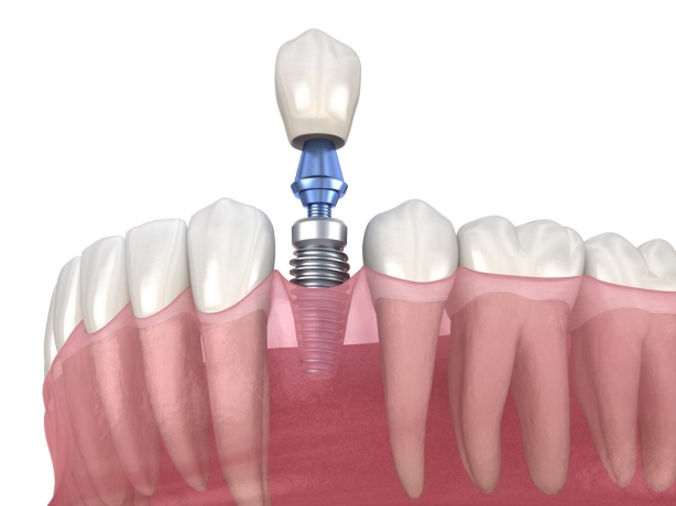 The Impact of Live Patient Training on Your Dental Implant Education