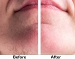 Your Long-Term Solution to Hair Removal in Peshawar