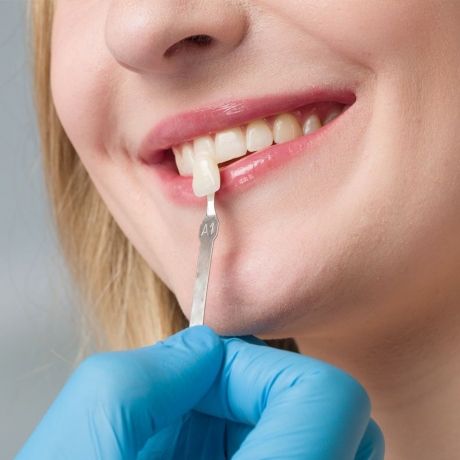 Can You Whiten Composite Veneers?