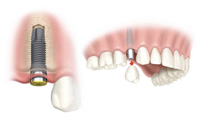 Full Mouth Dental Implants Cost Explained for Stress-Free Choices