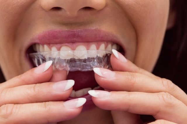 Mastering Case Planning in Invisalign Therapy: Why Specialized Training Matters
