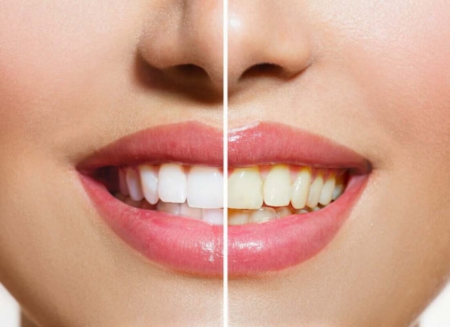How Often Should You Use Nano Teeth Whitening for Best Results?