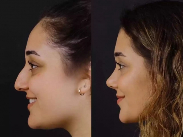 Affordable Options for Septoplasty in Dubai
