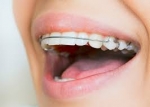 How Much Do Dental Appliances Cost?
