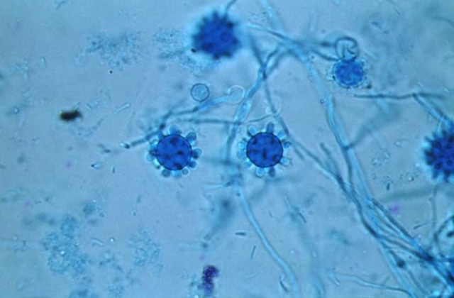 Histoplasmosis Treatment Market is Anticipated to Witness High Growth Owing to Rising Fungal Infection Rates