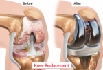 Knee Replacement Surgery in India: Restore Mobility with EdhaCare’s Expert Support