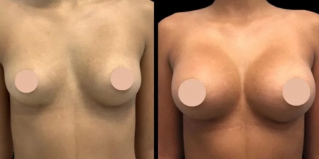 What to Expect from Breast Augmentation Surgery with the Best Breast Augmentation Surgeon in Dubai