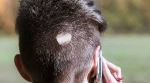 How Does the Best Trichologist for Bald Areas Diagnose?