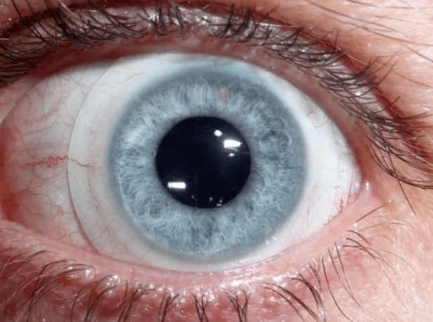 scleral contact lenses