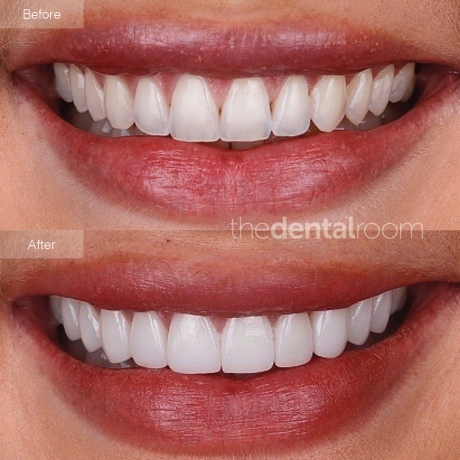 How Do I Maintain My Veneers Living in Dubai