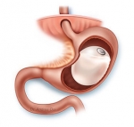 Can I Travel or Fly with a Gastric Balloon in My Stomach from Dubai