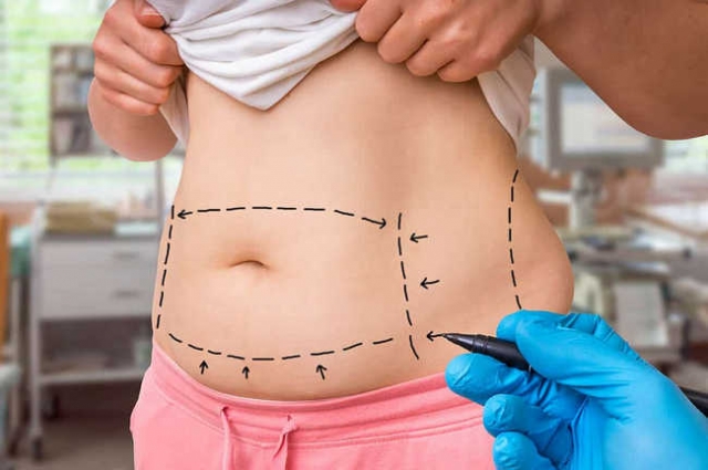 Is It Possible to Have a Tummy Tuck in Dubai If I Plan to Get Pregnant Again
