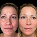 Top Benefits of Choosing Profhilo at the Best Aesthetic Clinics in Dubai
