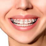 What Happens After Getting Metal Braces?