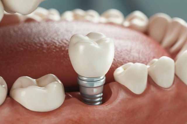 dentalimplantsnorwich