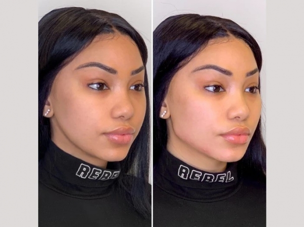 Step-by-Step :What to Expect During Thread Lift with the Best Plastic Surgeon in Dubai