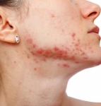 What Skin Diseases Should Expats Watch for in Dubai