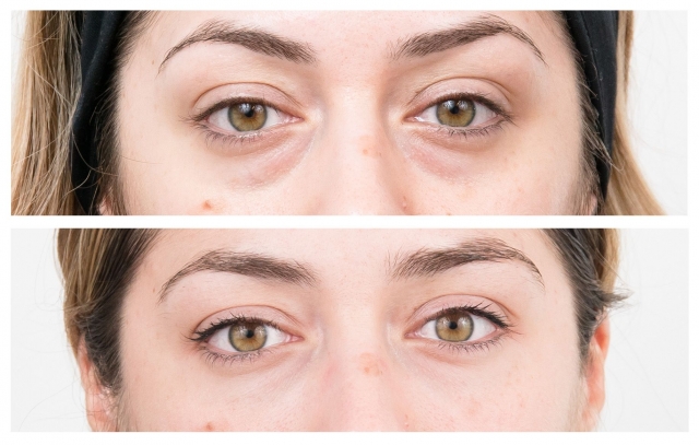 The Male Perspective on Blepharoplasty: Tailoring Surgical Techniques for Masculine Facial Aesthetics